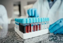 Photo of Какие анализы помогут оценить риск инсульта?